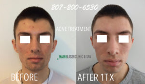 Before and after after 207 laser treatment